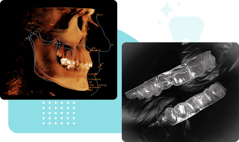 Dental Aligners